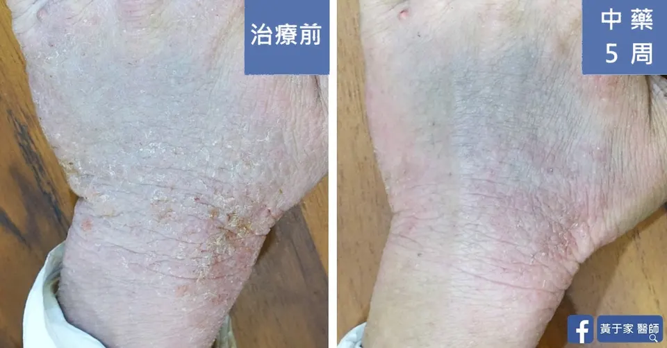 類固醇戒斷兩年患者手背與手腕治療前後對照（中藥 5 週）