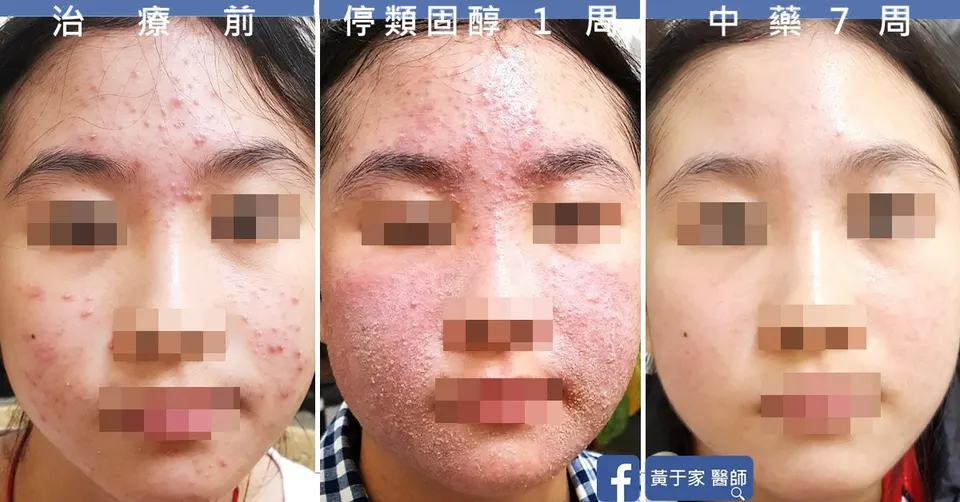 青春痘與類固醇依賴臉部對照：治療前、停類固醇 1 週、中藥 7 週