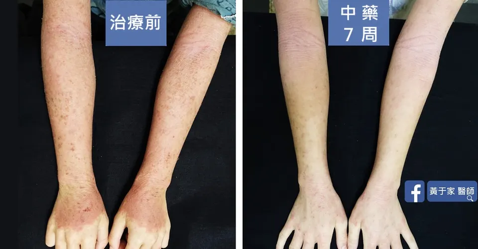 疑似類固醇戒斷患者雙前臂與手背，中藥 7 週前後對照