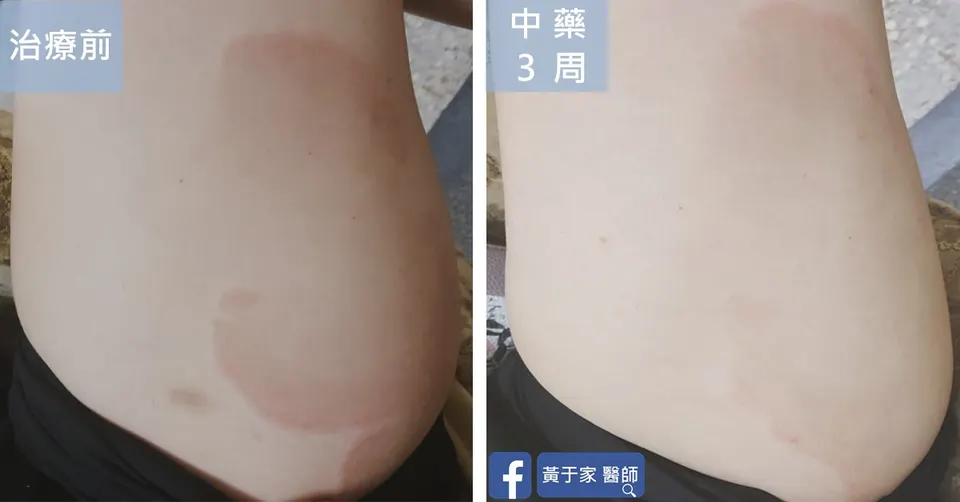 乾癬患者腰腹部紅斑，中藥 3 週前後對照