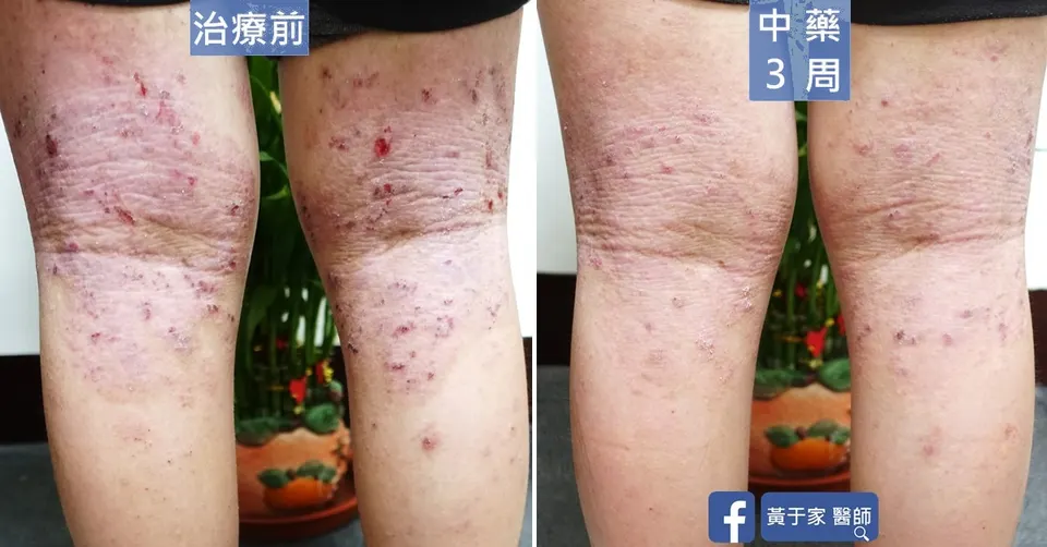 異位性皮膚炎患者膝窩與小腿，中藥 3 週前後對照
