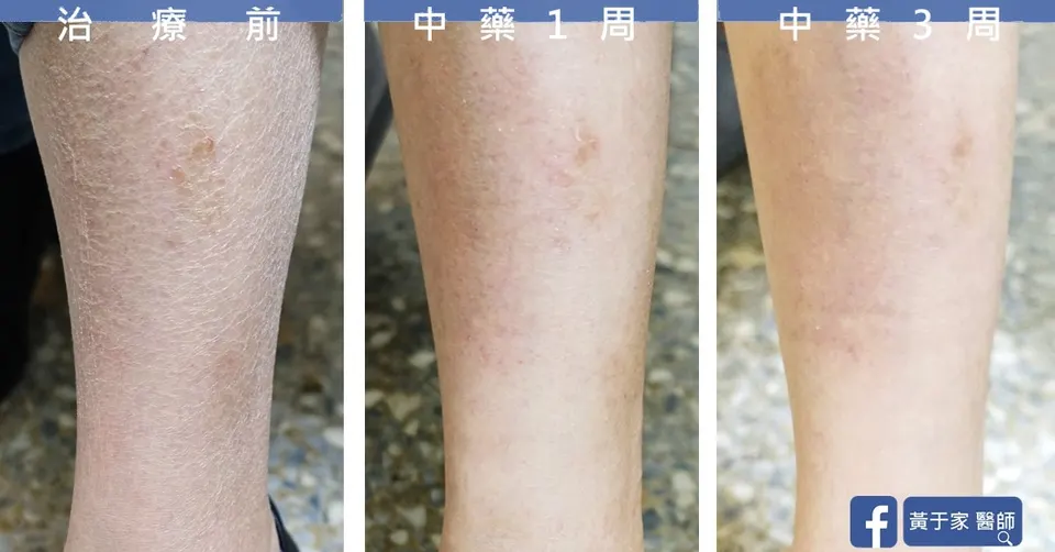 小腿皮膚乾燥脫屑，治療前與中藥 1 週、3 週對照