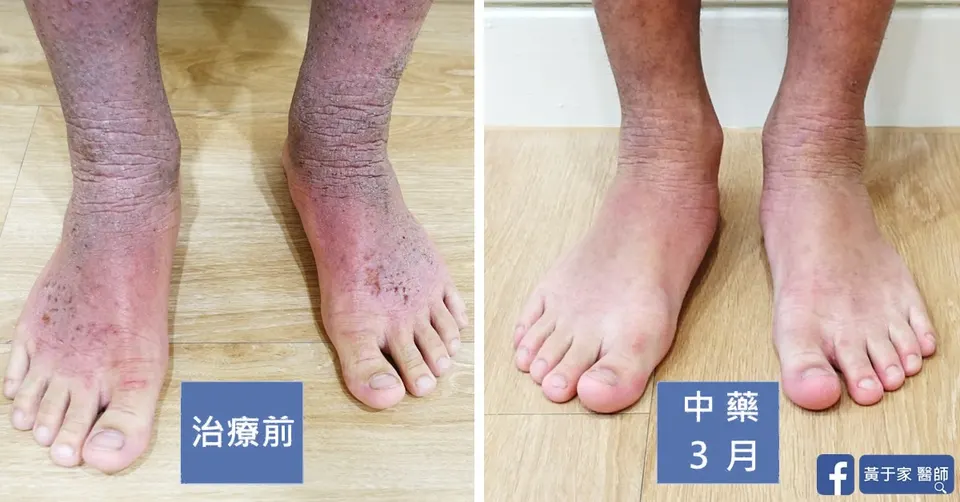 異位性皮膚炎國中生腳踝與足背，中藥 3 個月前後對照