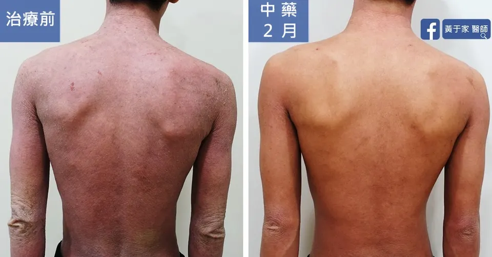異位性皮膚炎患者背部與手臂，中藥 2 個月前後對照