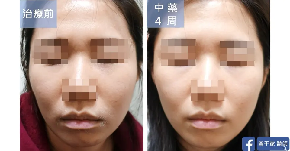 唇炎患者臉部與嘴角治療前後對照（中藥 4 週）