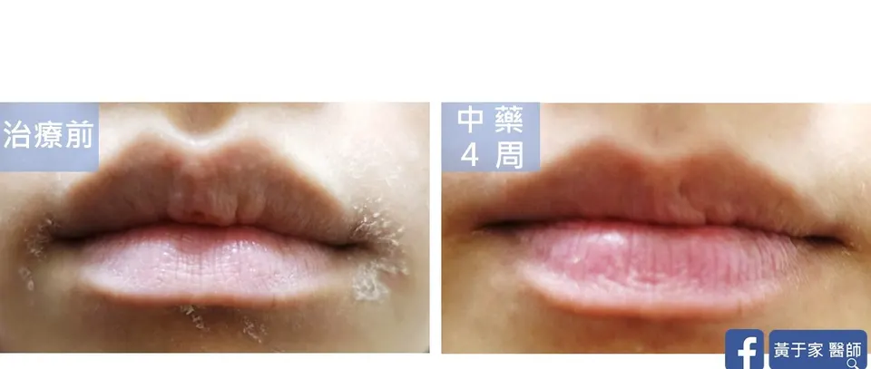 嘴唇周圍乾裂脫皮，中藥 4 週前後對照