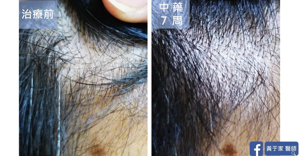 前額髮際頭皮與髮量，中藥 7 週前後對照