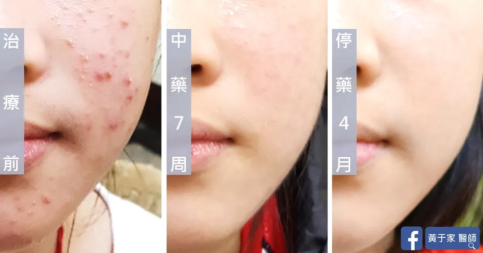 青春痘患者臉頰，治療前、中藥 7 週與停藥 4 個月對照