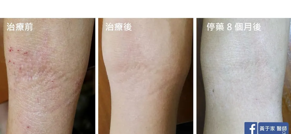 異位性皮膚炎手肘內側，治療前後與停藥 8 個月對照