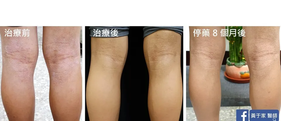異位性皮膚炎膝窩，治療前後與停藥 8 個月對照