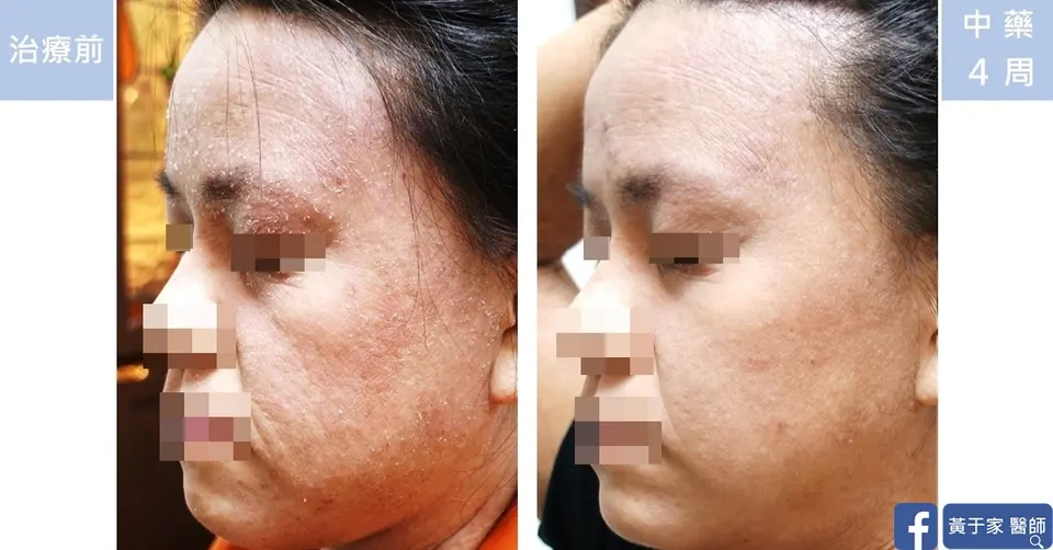 長期用類固醇患者側臉乾燥脫屑治療前後對照（中藥 4 週）