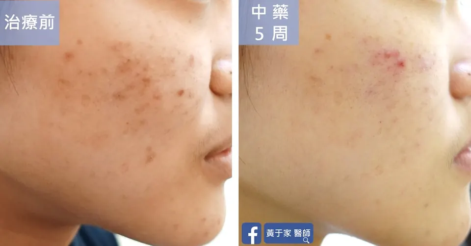 臉頰痘痘與色素沉著治療前後對照（中藥 5 週）