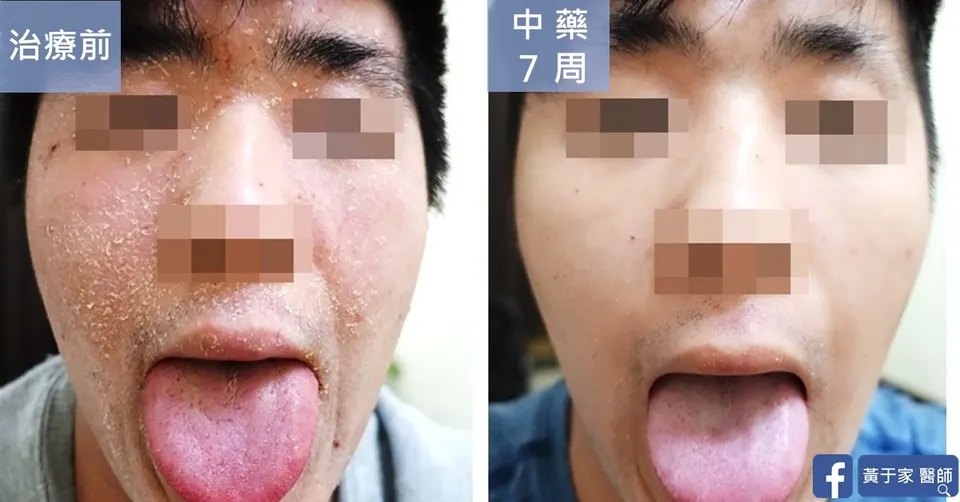 臉部類固醇戒斷脫屑與舌象治療前後對照（中藥 7 週）