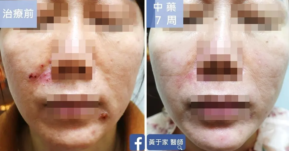 類固醇受損肌臉部治療前後對照（中藥 7 週）