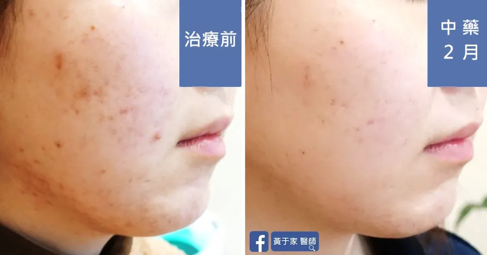 側臉痘疤與色素治療前後對照（中藥 2 個月）