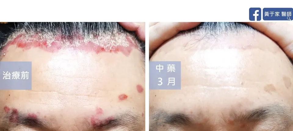 臉部乾癬額頭與眉間治療前後對照（中藥 3 個月）