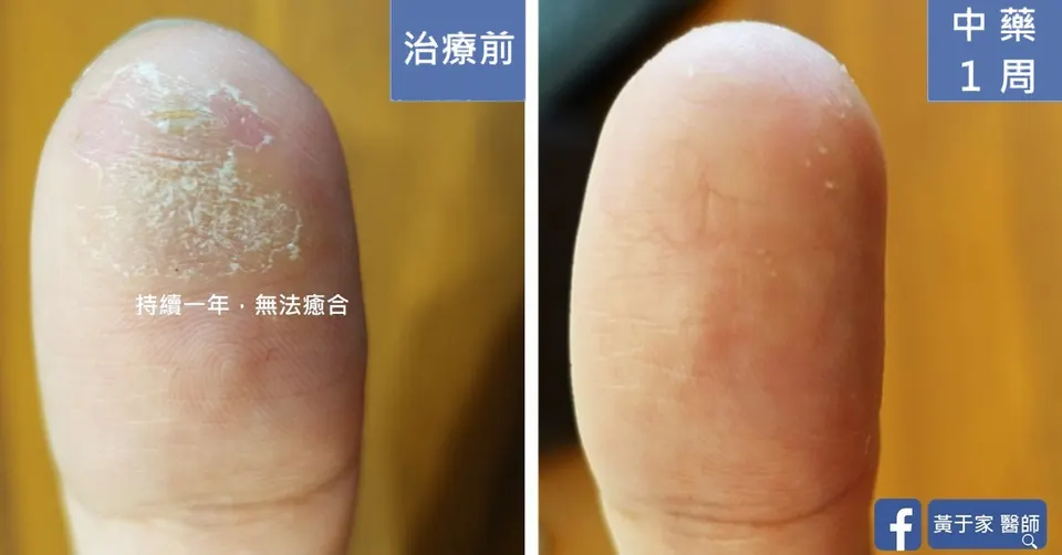 持續一年的皮膚破損，治療前後皮膚外觀比對（2）