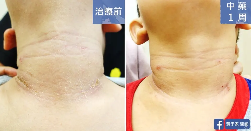 四歲異位性皮膚炎患者頸部，中藥 1 週前後對照