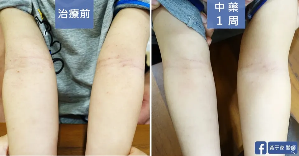 四歲異位性皮膚炎患者手肘內側，中藥 1 週前後對照