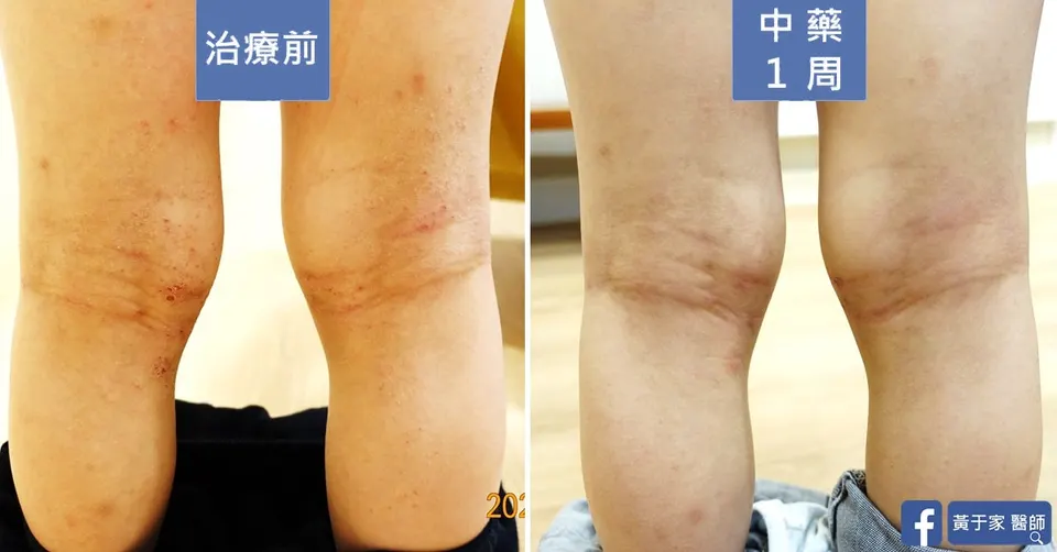 四歲異位性皮膚炎患者膝窩，中藥 1 週前後對照