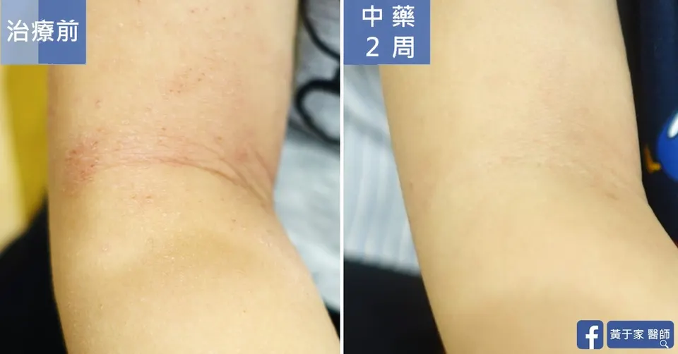 四歲異位性皮膚炎患者手肘內側特寫，中藥 2 週前後對照