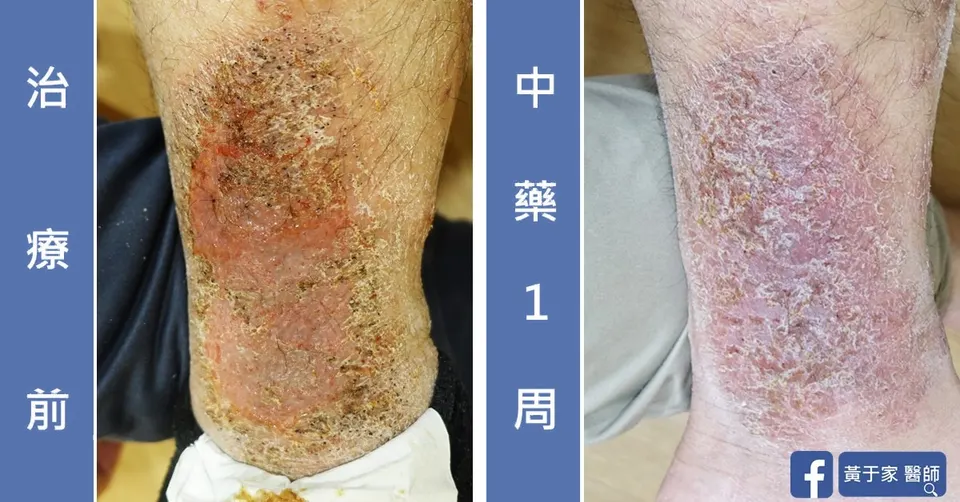 三個月無法癒合的傷口（圖 2）