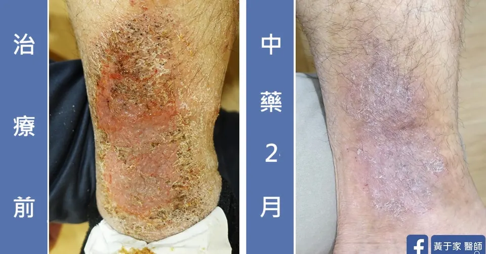 三個月無法癒合的傷口（圖 3）