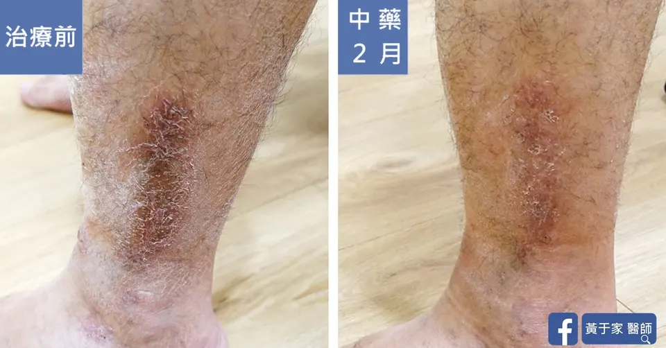 三個月無法癒合的傷口（圖 4）