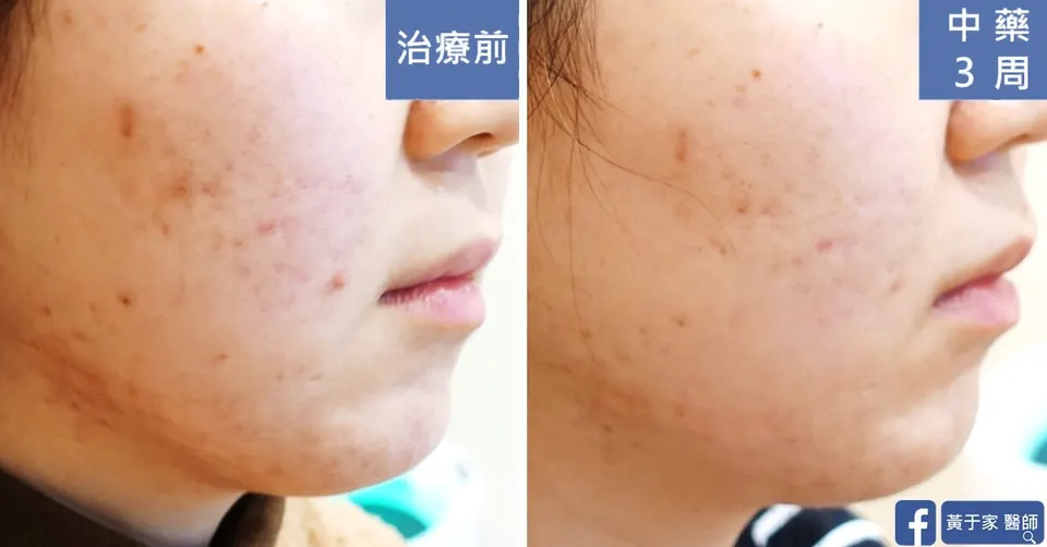 痤瘡患者臉頰痘疤，中藥 3 週前後對照
