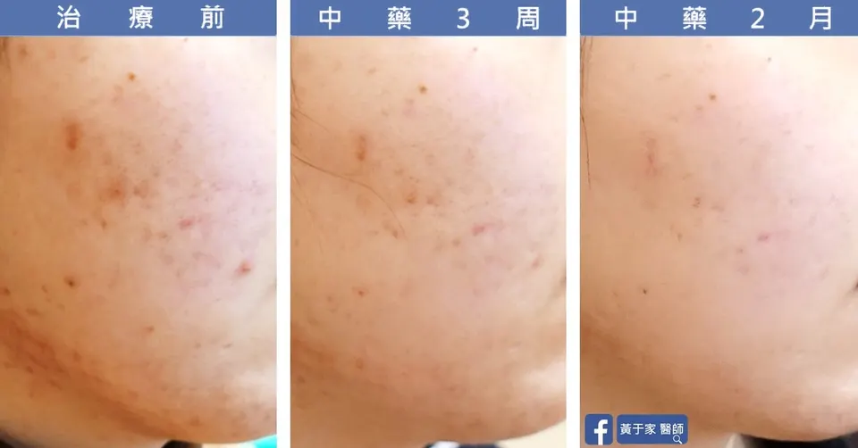 臉頰痘疤特寫，治療前與中藥 3 週、2 個月對照