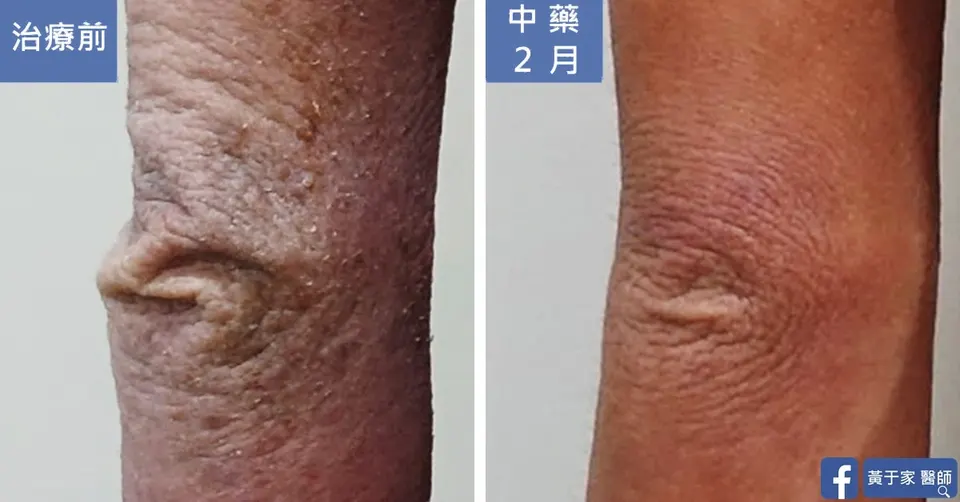 同一位患者膝蓋的近照比對，左標示「治療前」皮膚皺縮、布滿細小丘疹，右標示「中藥 2 月」