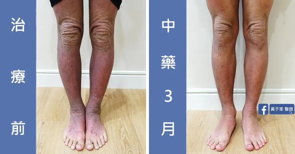 同一位患者小腿與雙腳的比對，左標示「治療前」，右標示「中藥 3 月」