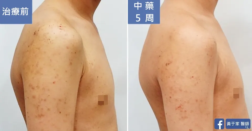 同一位男性患者右上臂與肩膀側面的比對，左標示「治療前」，散布紅色丘疹與抓痕；右標示「中藥 5 周」，丘疹減少