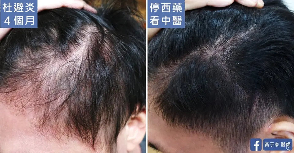 使用杜避炎 4 個月時與停西藥改看中醫後的頭頂髮量對照