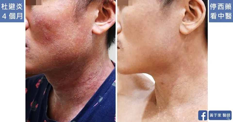使用杜避炎 4 個月時與停西藥改看中醫後的臉頰頸部對照