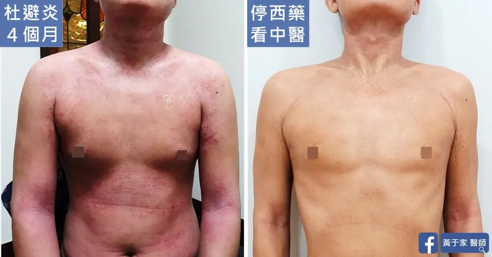 使用杜避炎 4 個月時與停西藥改看中醫後的胸腹身形對照