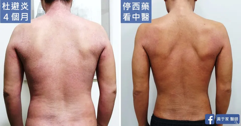 使用杜避炎 4 個月時與停西藥改看中醫後的背部對照