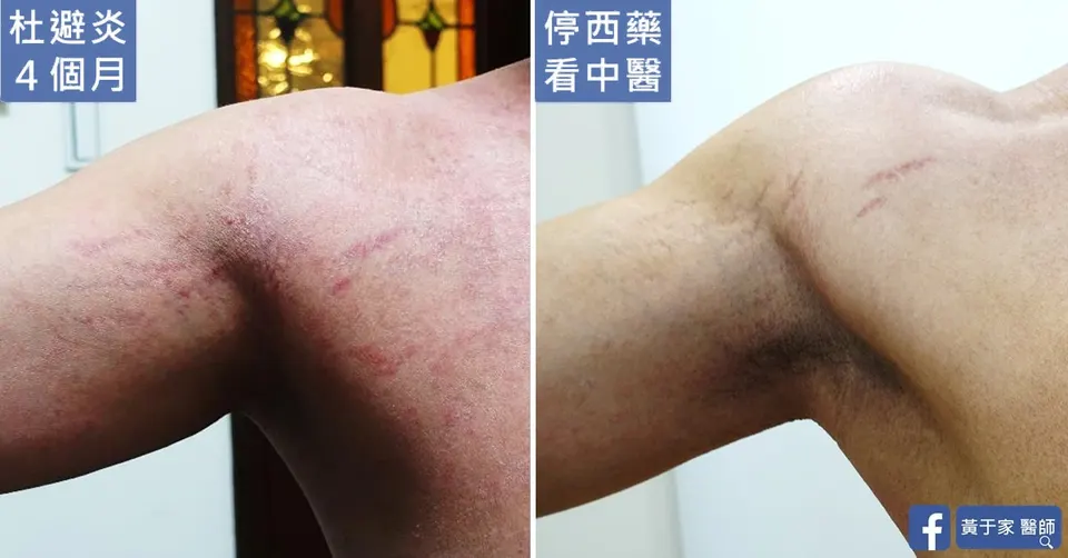 使用杜避炎 4 個月時與停西藥改看中醫後的腋下上臂對照