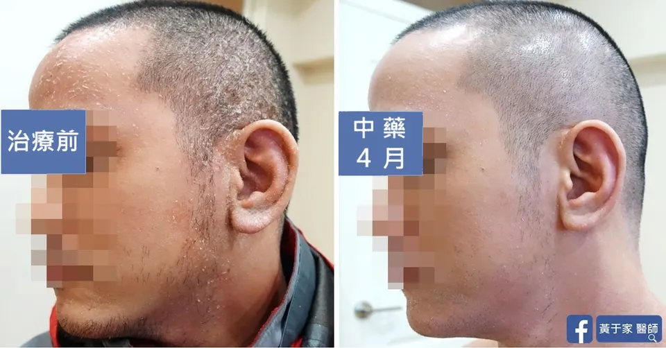 左側臉的比對，左標示「治療前」，右標示「中藥 4 月」
