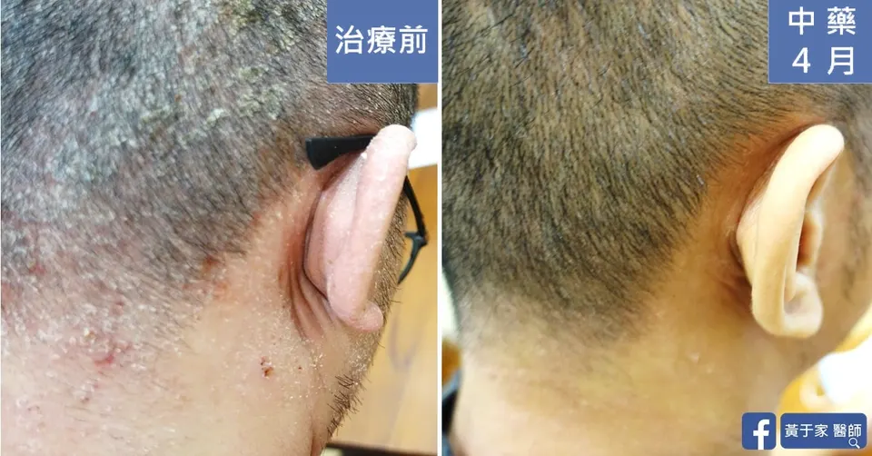 同一位患者右耳後與頸側的比對,左標示「治療前」,右標示「中藥 4 月」