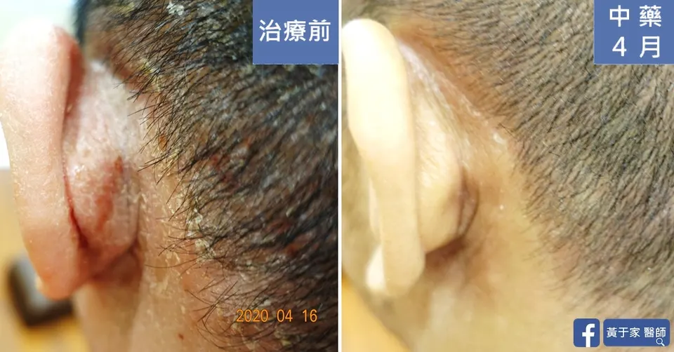 同一位患者左耳後的近照比對,左標示「治療前」,耳後紅腫脫屑;右標示「中藥 4 月」