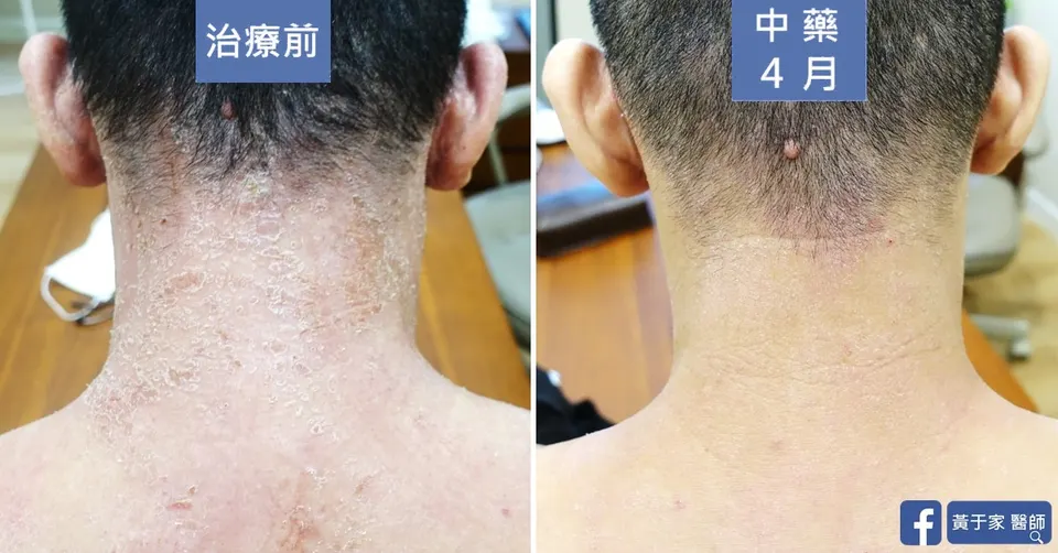 同一位患者後頸的比對,左標示「治療前」,後頸乾燥脫屑;右標示「中藥 4 月」