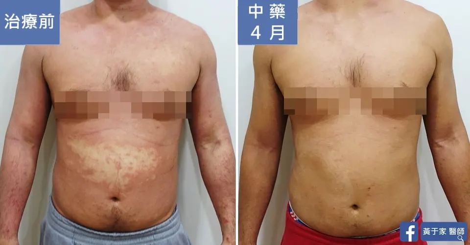 胸腹的比對，左標示「治療前」，右標示「中藥 4 月」