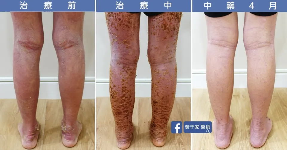 流過的眼淚都不會白費，治療前後皮膚外觀比對（2）