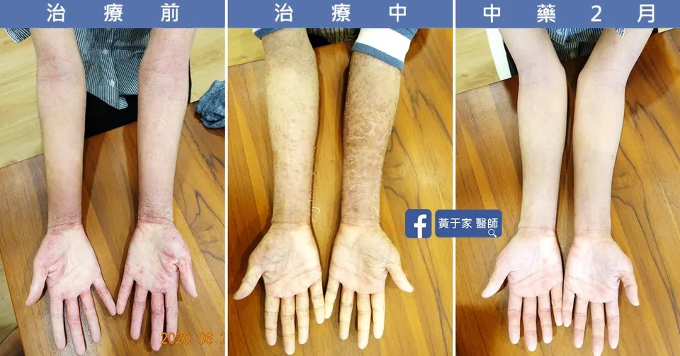 流過的眼淚都不會白費，治療前後皮膚外觀比對（3）
