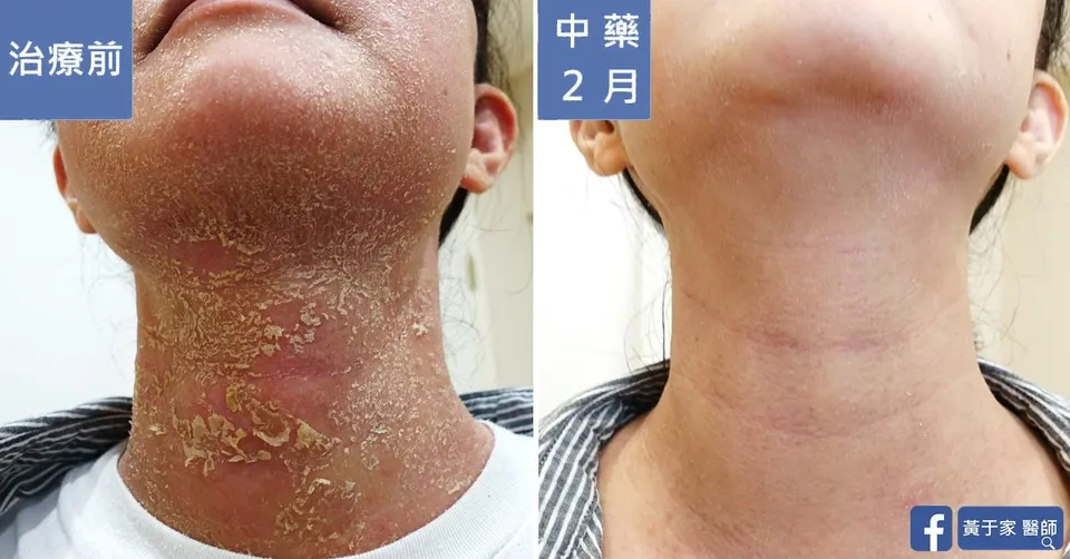 流過的眼淚都不會白費，治療前後皮膚外觀比對（4）