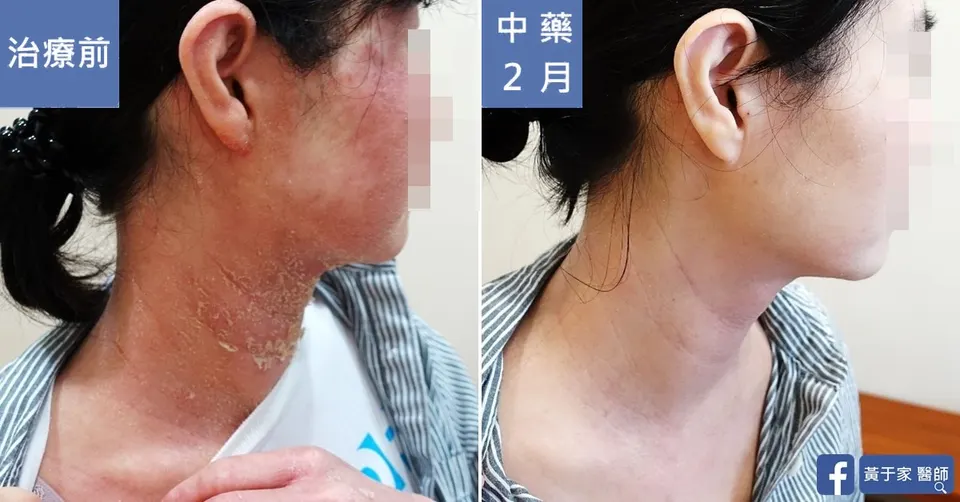 流過的眼淚都不會白費，治療前後皮膚外觀比對（5）