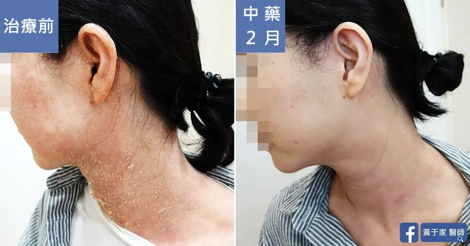 流過的眼淚都不會白費，治療前後皮膚外觀比對（6）
