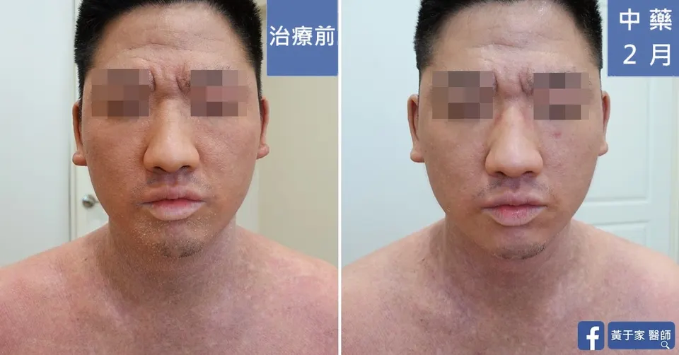 異位性皮膚炎，治療前後皮膚外觀比對（2）