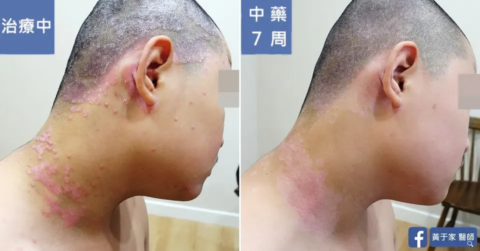 右耳後與頸部的比對，左標示「治療中」，右標示「中藥 7 周」